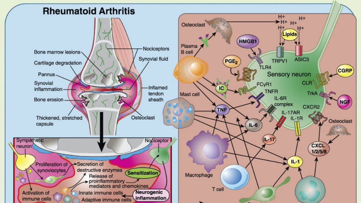 PAINthejournal's tweet photo. The January issue of #PAIN includes an article on cell–cell interactions in joint pain. https://t.co/8AV4TC9Jw5 https://t.co/AXRmEPbqjs