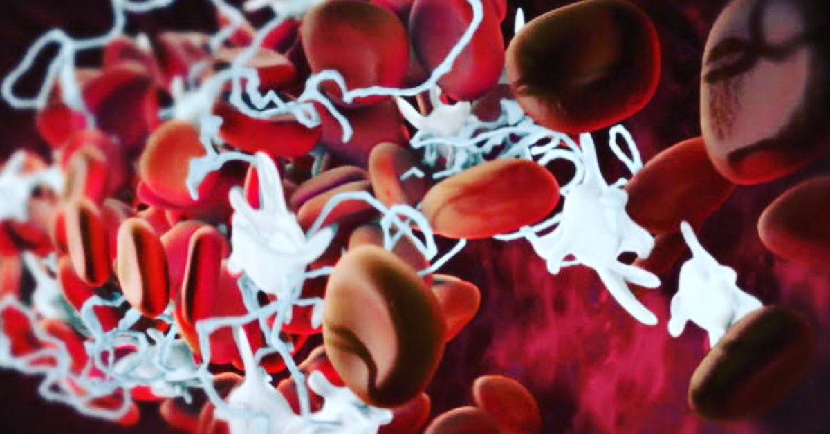LabClass1206's tweet image. La hemostasia es un mecanismo de defensa del organismo que se activa tras haber sufrido un traumatismo o lesión que previene la pérdida de sangre del interior de los vasos sanguíneos.
#laboratorio #hematologia #inmunologia #uroanalisis #parasitologia #hemostasia