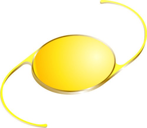 YELLOW intraocular lens after cataract surgery is PROTECTIVE against chromatic aberration under photopic conditions and protects the retina from ultraviolet light.