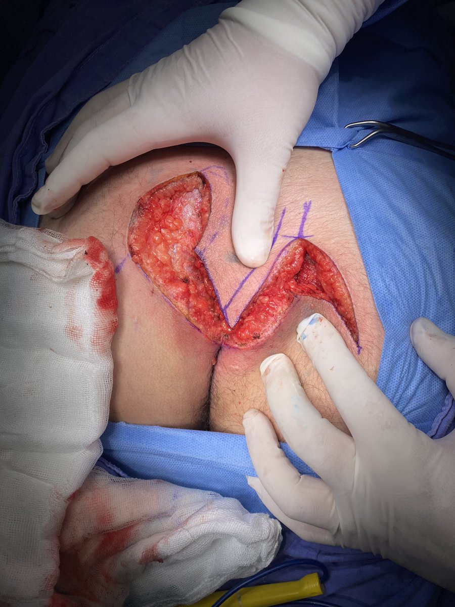 joucef's tweet photo. Bueno y en otros temas, hoy volvimos al jale.

Y el quiste PILONIDAL, con ayuda de cirugía plástica nos quedó bien. Esperamos evolución ídem del paciente 🤠#quistepilonidal #pilonidalcyst #ColorectalSurgery #soycoloproctomx https://t.co/afUUnc56Kn