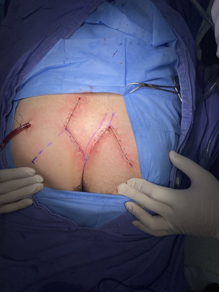 joucef's tweet photo. Bueno y en otros temas, hoy volvimos al jale.

Y el quiste PILONIDAL, con ayuda de cirugía plástica nos quedó bien. Esperamos evolución ídem del paciente 🤠#quistepilonidal #pilonidalcyst #ColorectalSurgery #soycoloproctomx https://t.co/afUUnc56Kn