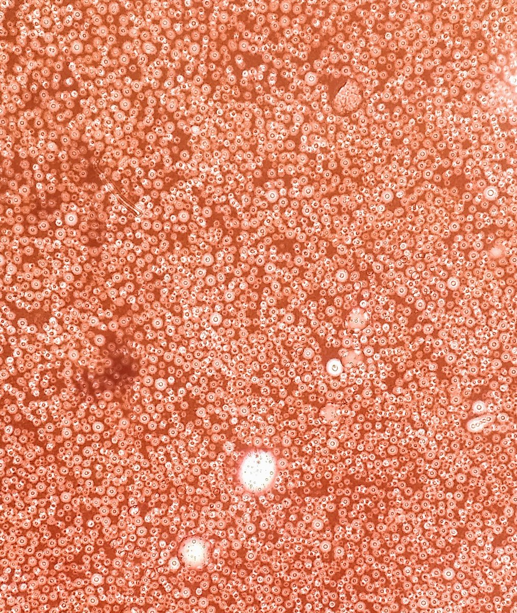 UMicologia's tweet image. #Cryptococcus #PVVS #AIDS 
#pandemic 
Collateral damage
CSF Indian Ink