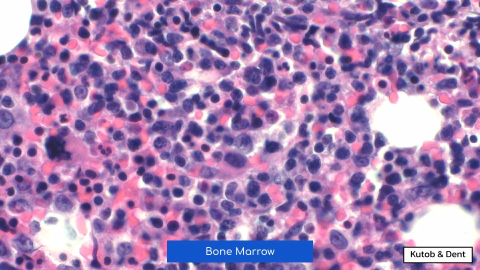 EmoryPathology's tweet photo. EMORY CASE OF THE WEEK #61:

55♂️ w/ weight loss, syncope, thrombocytopenia, &amp; suspected myelodysplastic syndrome.
Peripheral smear &amp; bone marrow biopsy show the following.
Contributors: Leila Kutob &amp; Alex Dent, MD (@isitcancer)

#hemepath #pathresidents #Emorypathres #EmoryCoTW https://t.co/edGL4Co1Sh