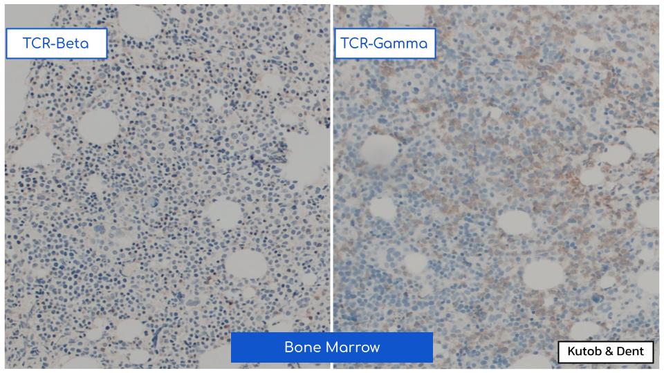 EmoryPathology's tweet photo. EMORY CASE OF THE WEEK #61:

55♂️ w/ weight loss, syncope, thrombocytopenia, &amp; suspected myelodysplastic syndrome.
Peripheral smear &amp; bone marrow biopsy show the following.
Contributors: Leila Kutob &amp; Alex Dent, MD (@isitcancer)

#hemepath #pathresidents #Emorypathres #EmoryCoTW https://t.co/edGL4Co1Sh