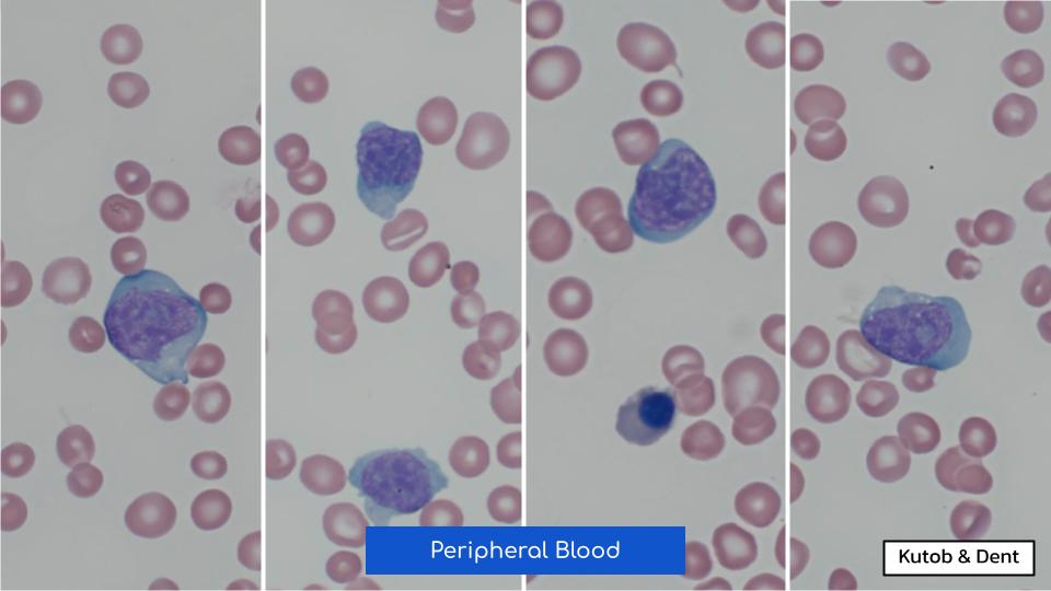 EmoryPathology's tweet photo. EMORY CASE OF THE WEEK #61:

55♂️ w/ weight loss, syncope, thrombocytopenia, &amp; suspected myelodysplastic syndrome.
Peripheral smear &amp; bone marrow biopsy show the following.
Contributors: Leila Kutob &amp; Alex Dent, MD (@isitcancer)

#hemepath #pathresidents #Emorypathres #EmoryCoTW https://t.co/edGL4Co1Sh