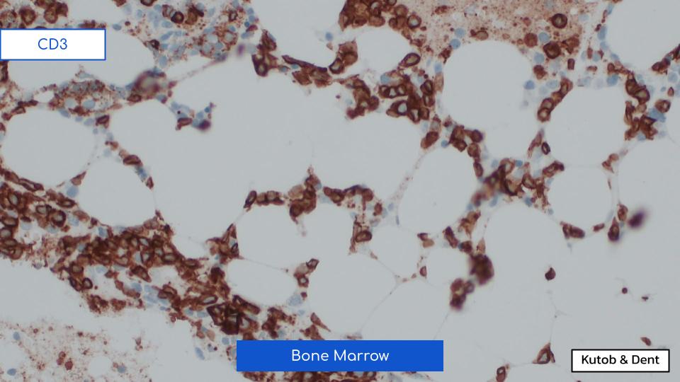 EmoryPathology's tweet photo. EMORY CASE OF THE WEEK #61:

55♂️ w/ weight loss, syncope, thrombocytopenia, &amp; suspected myelodysplastic syndrome.
Peripheral smear &amp; bone marrow biopsy show the following.
Contributors: Leila Kutob &amp; Alex Dent, MD (@isitcancer)

#hemepath #pathresidents #Emorypathres #EmoryCoTW https://t.co/edGL4Co1Sh