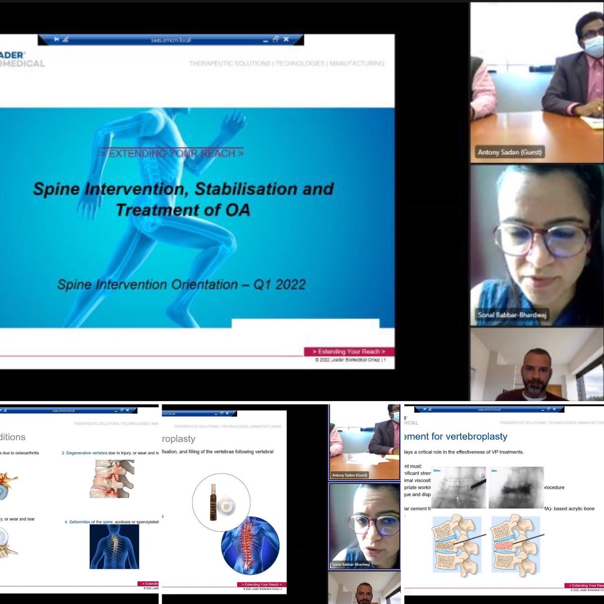 #neverstoplearning #alwaysbelearning #alwayscurious 
#customerexperience #trainingsession 
#customisedsolutions #spinecare #spineintervention #spinestabilisation #adcongel #antiadhesion #fbss #vebroplast #vertebroplasty Interested? learning@leaderbiomedical.com
#alwayslearning