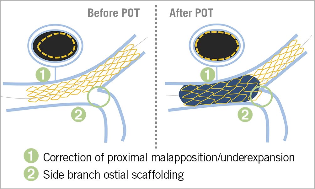 AsiaIntervention (@asiainterv) on Twitter photo "In addition to the recognised quality markers such as POT and KBI, we discuss the clinical relevance of the operator’s LM PCI experience and the intracoronary imaging guidance when treating patients with left main disease." by <a href="/MilasinD18/">Dejan Milasinovic</a> & <a href="/GoranEBC/">Goran Stankovic, MD, PhD</a>
bit.ly/3m2rVQN "In addition to the recognised quality markers such as POT and KBI, we discuss the clinical relevance of the operator’s LM PCI experience and the intracoronary imaging guidance when treating patients with left main disease." by <a href="/MilasinD18/">Dejan Milasinovic</a> & <a href="/GoranEBC/">Goran Stankovic, MD, PhD</a>
bit.ly/3m2rVQN