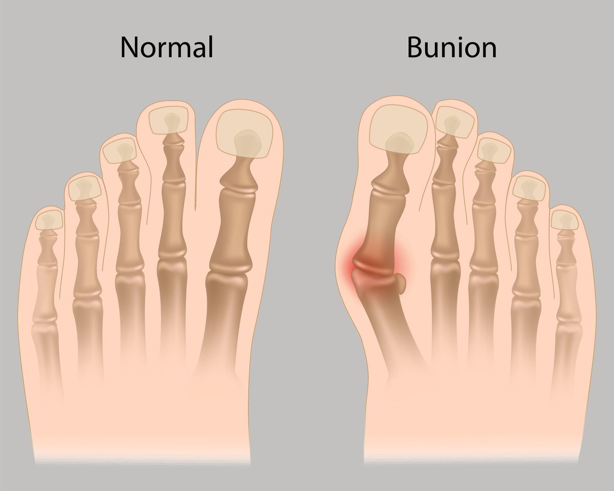 bay_podiatry's tweet photo. It's not unusual to develop a #bunion or hammertoe with age. Have you noticed changes to foot shape? See #BrooklynNYpodiatrist #ArgiriosMantzoukasDPM for examination, diagnosis, and treatment. https://t.co/g3QoET5Oia
#BrooklynNYFootDoctor #KingsCountypodiatrist #buniondoctor https://t.co/syuXgu7Blk