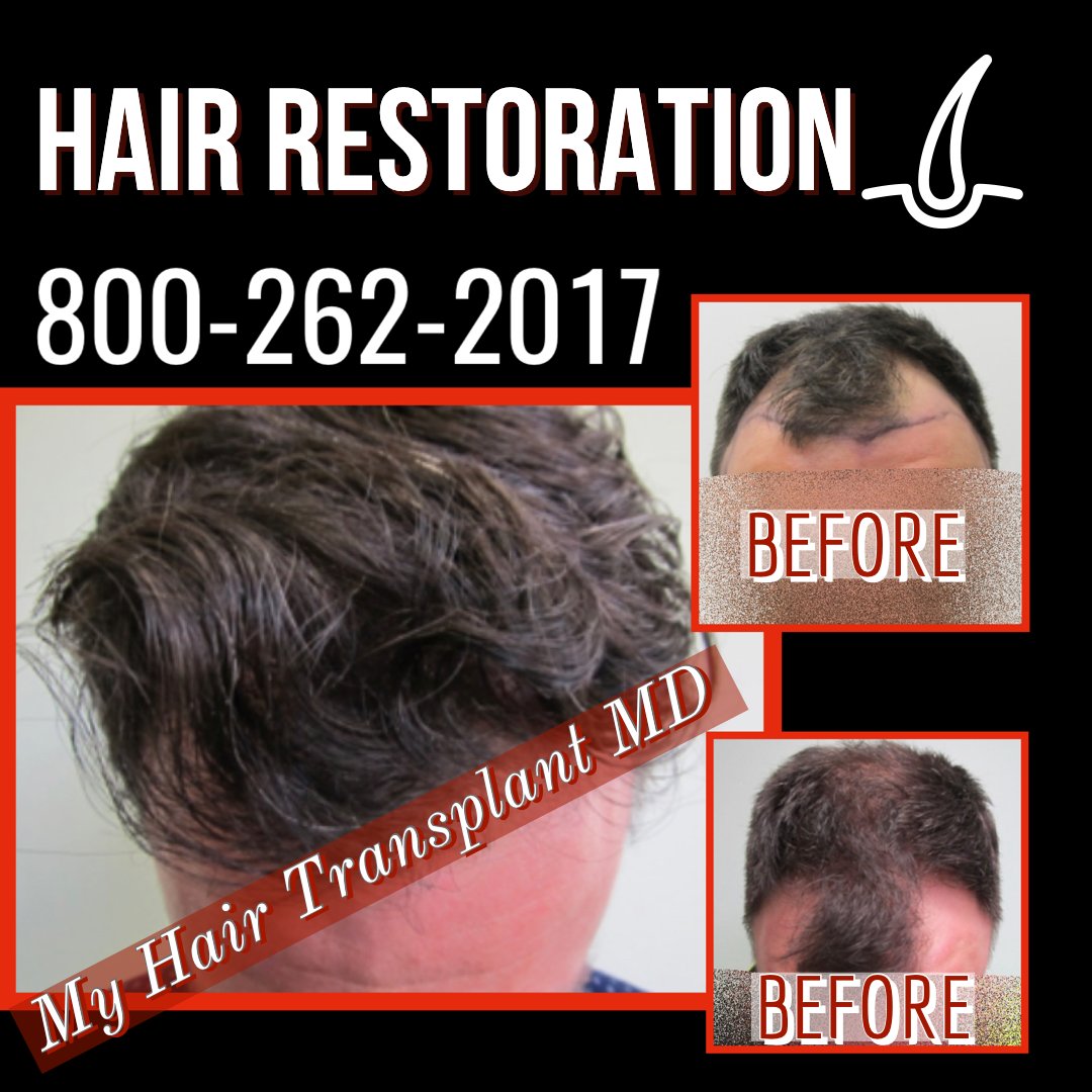 تويتر \ MyHairTransplantMD على تويتر: تويتر \ MyHairTransplantMD على تويتر: