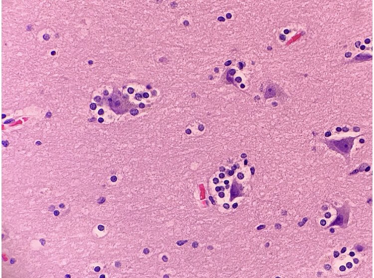 JaredAhrendsen's tweet photo. An interesting example of exuberant (but benign!) perineuronal satellitosis of glial cells around neurons, originally described by Ramón y Cajal. This feature is recapitulated by neoplastic glial cells in infiltrating gliomas, as described by Hans Joachim Scherer. #neuropath 🧠 https://t.co/lxqKAxRohK