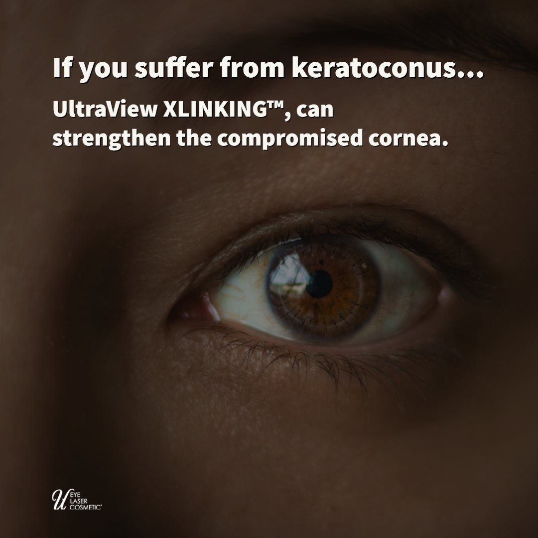 uelc_ca's tweet photo. If you suffer from keratoconus, UltraView XLINKING™, a corneal cross-linking treatment, can strengthen the compromised cornea and improve your vision. Learn more here: https://t.co/0T2zHbaVK1   
 
#UELC  #UltraViewXLinking #keratoconus https://t.co/Ywmv31r7Me
