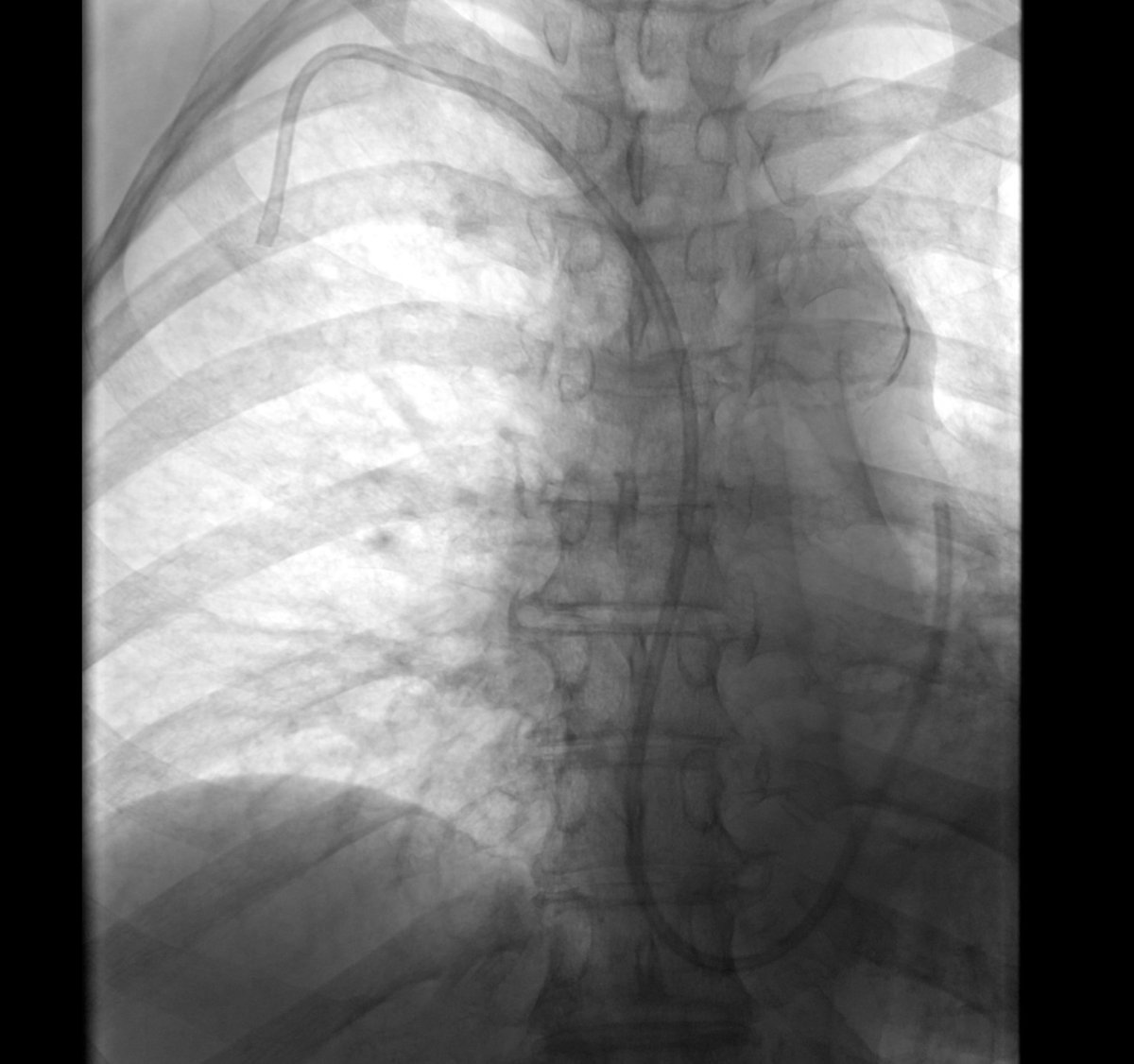 MTV_IR's tweet photo. Patient referred for malfunctioning port. #seriously https://t.co/TgcZ8B0lZ0