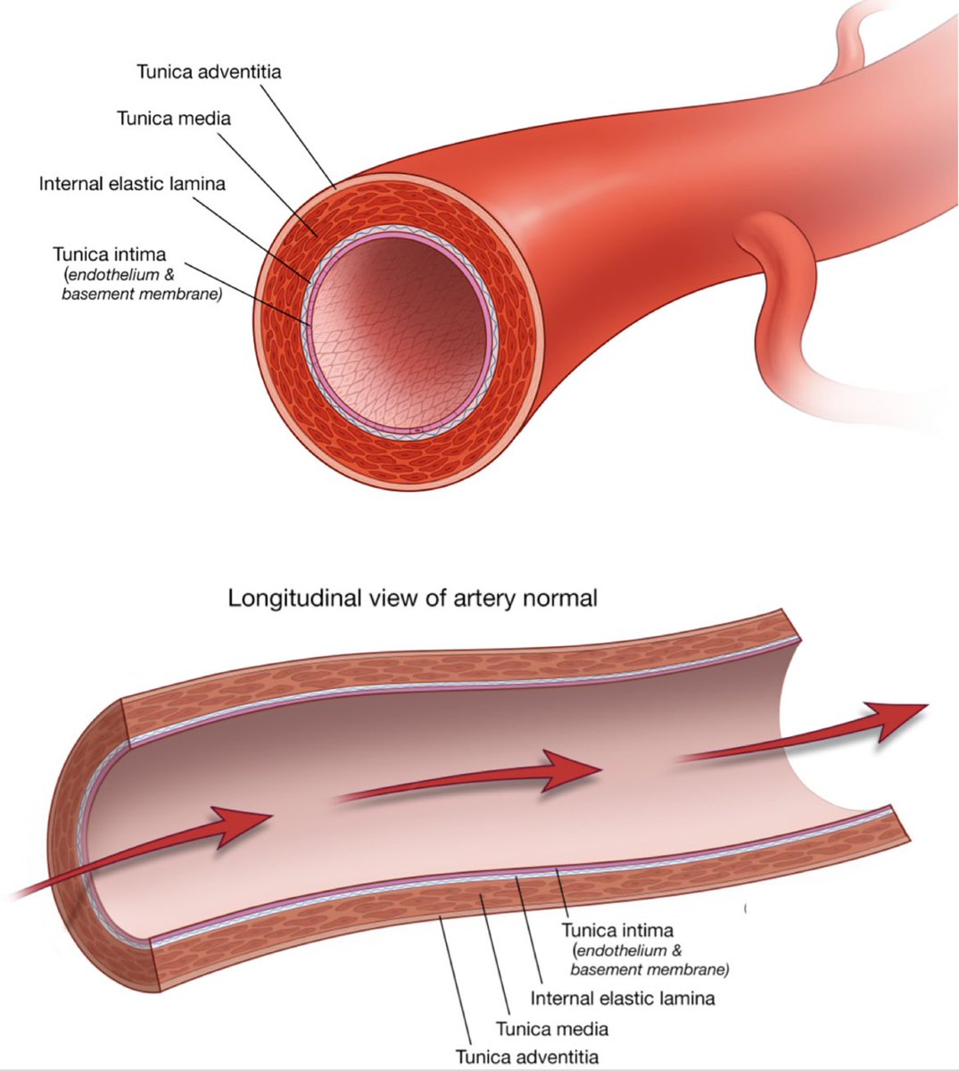 WorldStrokeEd's tweet photo. #MondayTip

#Intracranial vessels:
☝🏼#No external elastic lamina
☝🏼#Paucity of elastic fibers in the media
☝🏼Very #thin or even absent #adventitia

Remember these features when approaching &amp; managing  intracranial #disecctions

Check 👉 https://t.co/fDrJG9W1mK https://t.co/pukj8Zt2RO