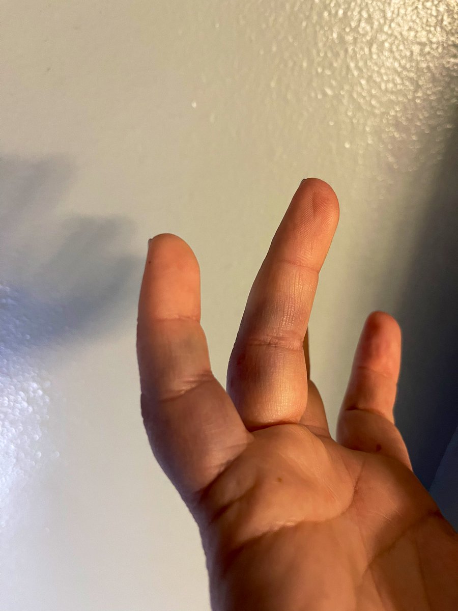 bdcooley24's tweet photo. day one of season and I already have two broken fingers. at least she hit it up the middle right? π€¦πΌββοΈ #thoselaces #finishedbp https://t.co/PISzAZ4gkQ