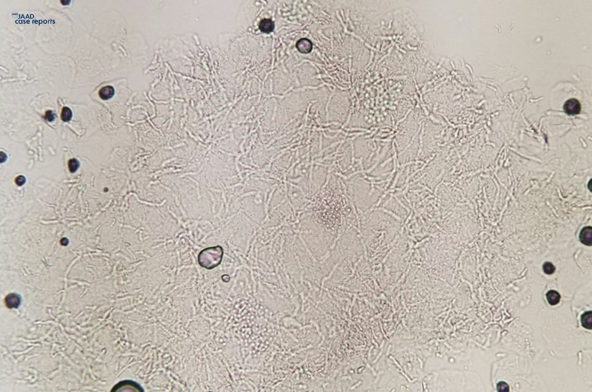 Generalized tinea versicolor following initiation of ixekizumab therapy bit.ly/3FQPuD0