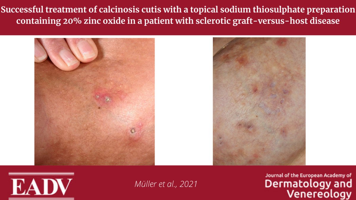 Topical topical sodium thiosulphate appears to be a promising treatment option for #CalcinosisCutis. However, the optimum composition and therapeutic effectiveness in a larger number of patients remain to be evaluated in future trials.>> https://t.co/rOlPIzI24U https://t.co/ylbHSQjss2