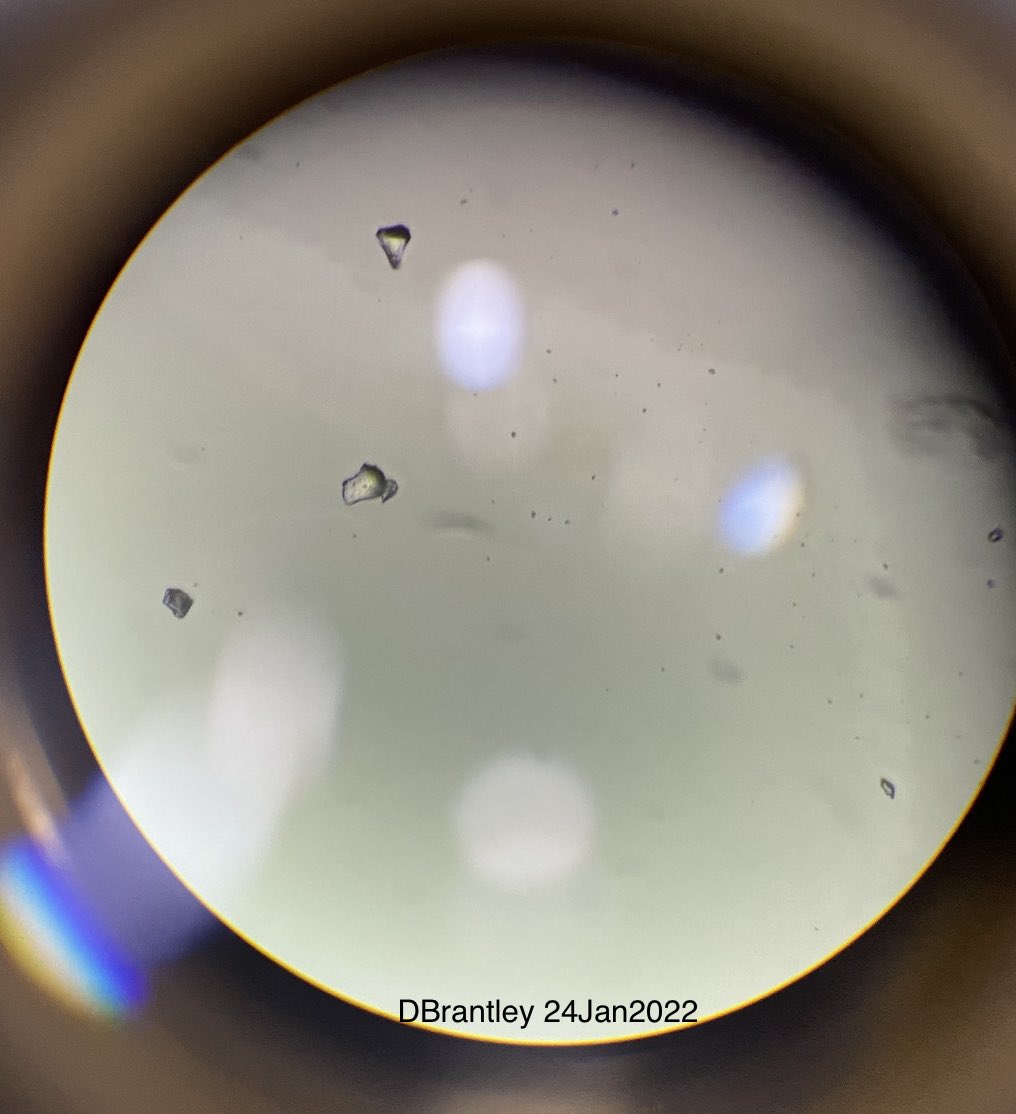 tammbrant's tweet image. Finally found a compassionate, inquisitive doc who checked long covid blood with a microscope and found what seems to be microclots. Seeking to possibly replace mini heparin injections rx with combo of aspirin, clopidogrel, and eliquis #TeamClots #bioclots  More brave docs needed