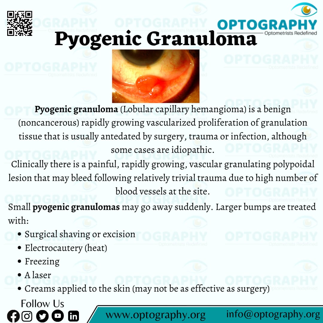 Optography8's tweet photo. Pyogenic granulomas are small, raised, and red bumps on the skin. The bumps have a smooth surface and may be moist. They bleed easily because of the high number of blood vessels at the site.
#pyogenicgranuloma #eyecare #optometry #Optography #dilseoptometrist https://t.co/zs7dx353s2