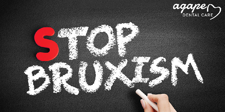 AgapeDentalCare's tweet photo. Follow these tips to manage or reduce the impact of bruxism: 😬🦷
- Reduce stress
- Avoid stimulating substances in the evening or night
- Practice healthy sleeping habits
- Consult a dentist for help #Bruxism 
 #agapedentalcare 
 #BremertonDentist #Practina https://t.co/SKt4aBTJM5