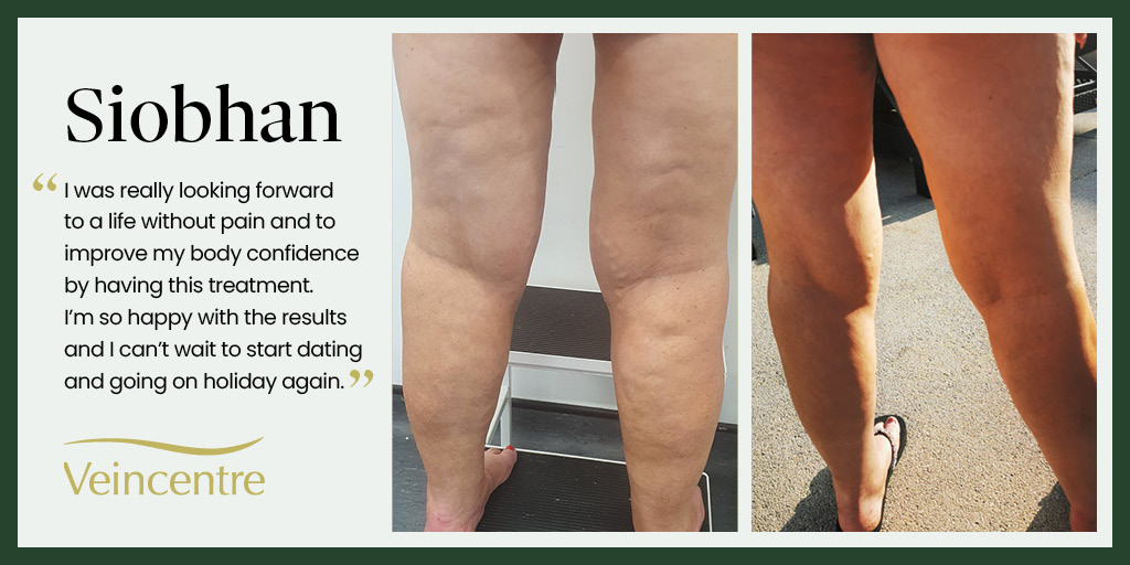 Siobhan, lost eight stone in weight. Although her body image improved, she wasn’t happy with the cosmetic appearance of her varicose veins but most importantly she experienced physical symptoms such are tiredness, aching, discomfort and pain. 

Read more: veincentre.com/about/case-stu…