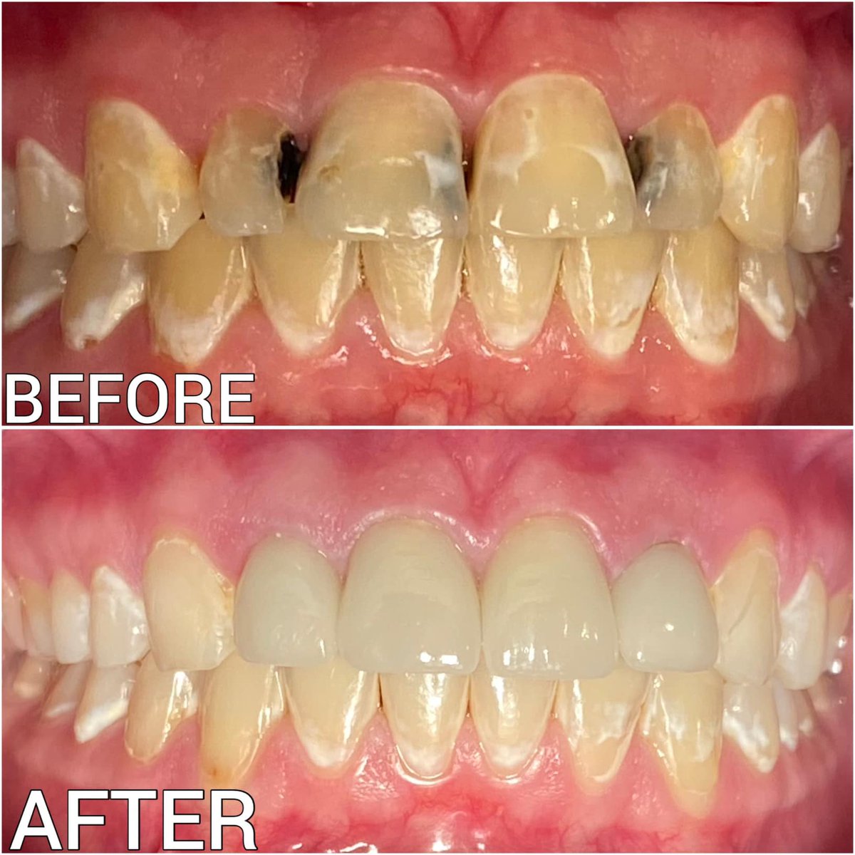 ***TRANSFORMATION TUESDAY*** 
This patient presented with a desire to improve her smile.  Dr. Bobby F. Shunnarah completed 4 anterior Aesthetic Bruxzir crowns on top and provided at home Opalescence Go Bleaching. Our sweet patient was very pleased with her newly improved smile.