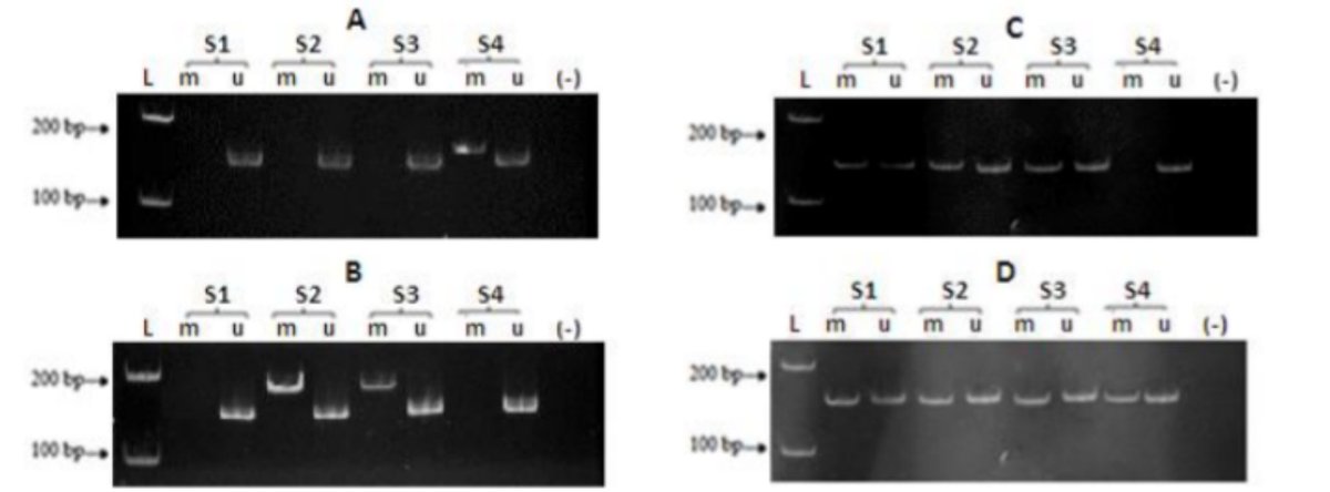 JabetEditor's tweet photo. #Aberrant methylation of #CDKN2A, #RASSF1A and #WIF1 in sporadic adenocarcinomatous colorectal #cancer: Associations with #clinicopathological #features
https://t.co/4SdlnDya0w https://t.co/y4T8oTCdv2
