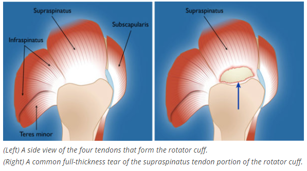 drchrisahmad's tweet photo. Are there different types of #RotatorCuff #tears❓
What are they❓ What causes them ❓
Find Out Here: https://t.co/bfcoGqdQN0 ✅
@OrthoColumbia @nyphospital
#shoulder #shoulderpain #shouldersurgery #shoulderdoctor #pain #orthopedics #tendons #impingement #skill ⭐️⭐️⭐️⭐️⭐️ https://t.co/GTYSYdhhBD