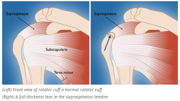 drchrisahmad's tweet photo. Are there different types of #RotatorCuff #tears❓
What are they❓ What causes them ❓
Find Out Here: https://t.co/bfcoGqdQN0 ✅
@OrthoColumbia @nyphospital
#shoulder #shoulderpain #shouldersurgery #shoulderdoctor #pain #orthopedics #tendons #impingement #skill ⭐️⭐️⭐️⭐️⭐️ https://t.co/GTYSYdhhBD