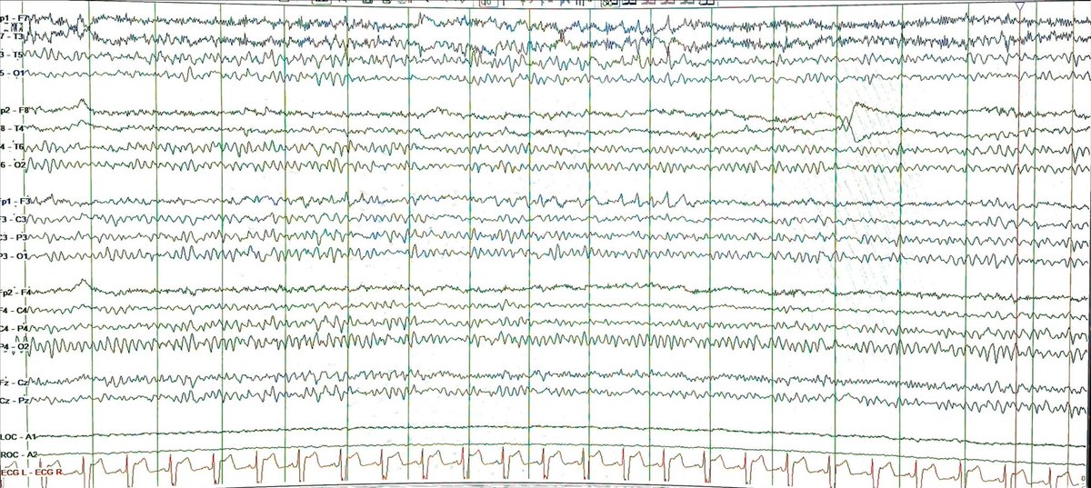 Fbabtain's tweet photo. What is the likely anatomical localization of the seizure in this #EEG?
A) Right temporal
B) Left temporal
C) Right frontal
D) Left frontal
@EEGTalk
@TheNotoriousEEG
#TwitterMD
#MedTwitter
#EEGtutorial
#Epilepsy
#Neurology
#Neuroscience
#فضفضة_طبيب https://t.co/6BeJtZk0Fe