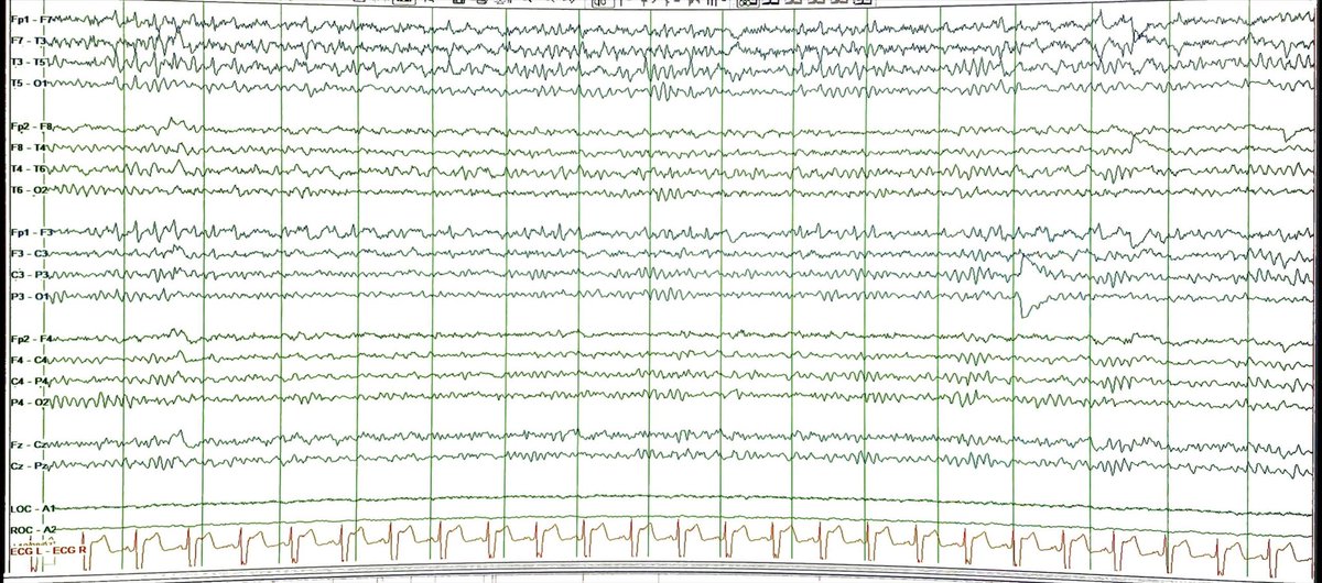 Fbabtain's tweet photo. What is the likely anatomical localization of the seizure in this #EEG?
A) Right temporal
B) Left temporal
C) Right frontal
D) Left frontal
@EEGTalk
@TheNotoriousEEG
#TwitterMD
#MedTwitter
#EEGtutorial
#Epilepsy
#Neurology
#Neuroscience
#فضفضة_طبيب https://t.co/6BeJtZk0Fe