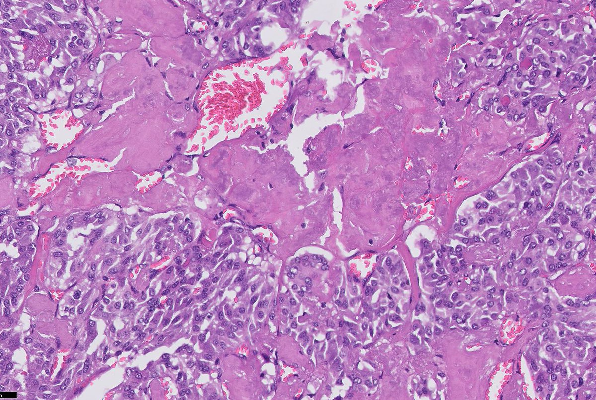 Tiger_heme's tweet photo. What is the positive immunostain in this nodule? https://t.co/pRj0CSHJ9R