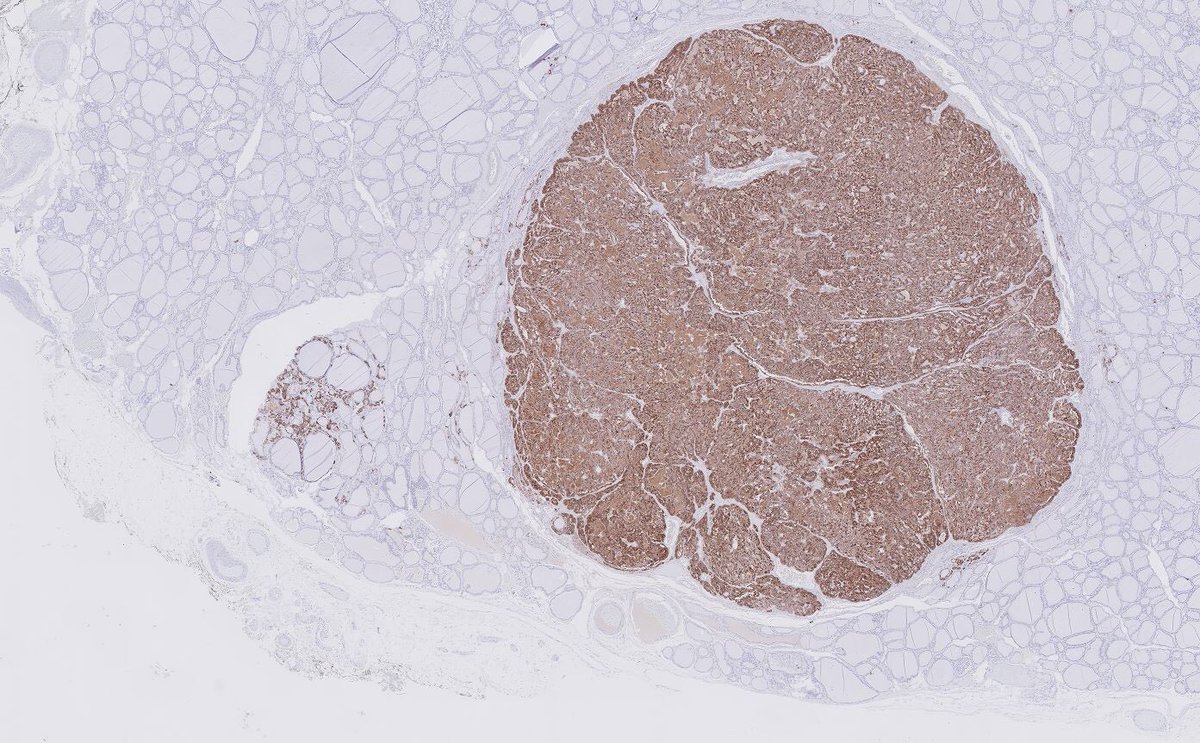 Tiger_heme's tweet photo. What is the positive immunostain in this nodule? https://t.co/pRj0CSHJ9R