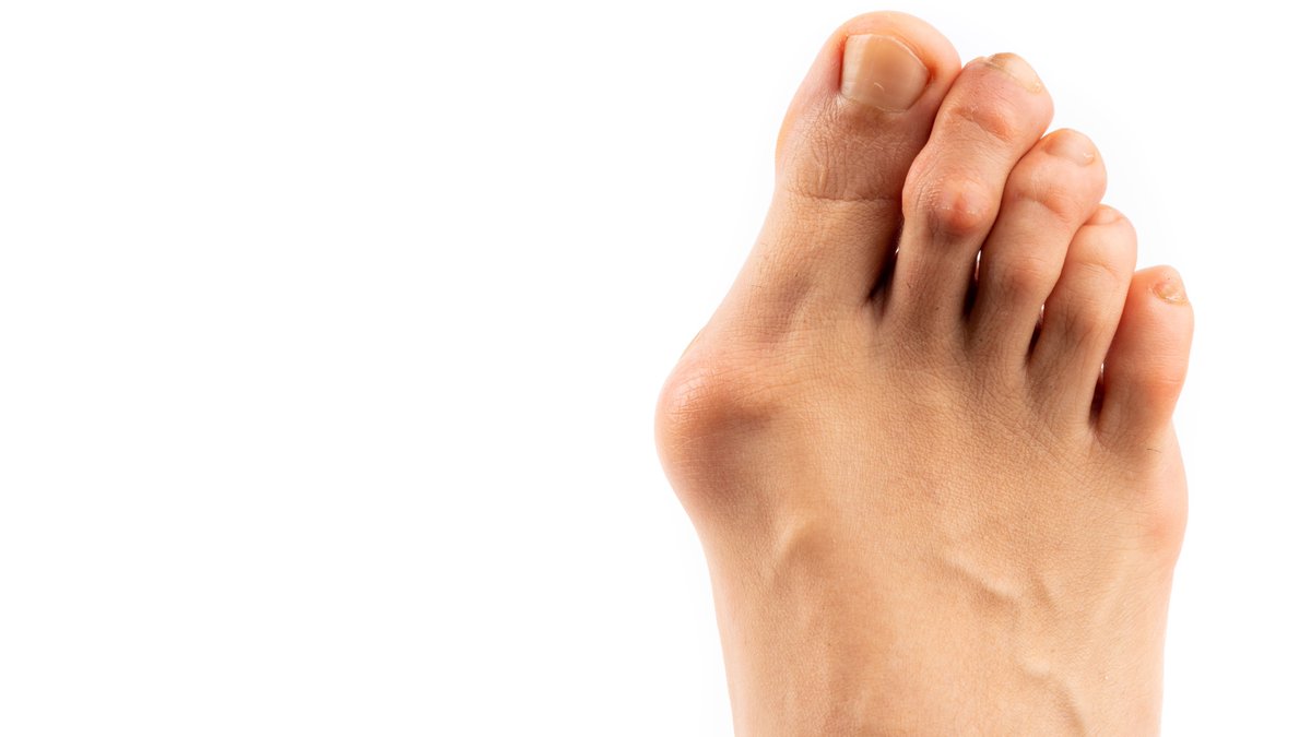 Bunions can prevent you from doing the things you love and interfere with your foot’s natural function. See how we can give you back proper mobility, here idahofoot.com/practice_areas…