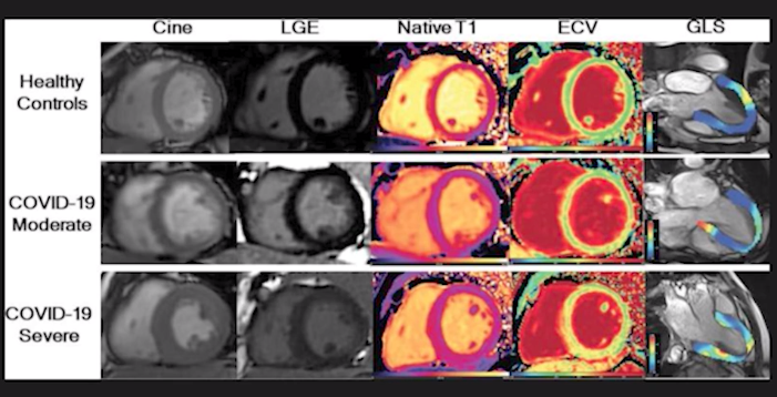 Diagnostic and Interventional Cardiology magazine (@daiceditor) on Twitter photo VIDEO: Long-COVID Presentations in Cardiology at Beaumont Hospital — Interview with Justin Trivax, MD, Beaumont Hospital
dicardiology.com/videos/video-l…
#longhaulers <a href="/BeaumontHealth/">Beaumont Health</a> #myocarditis VIDEO: Long-COVID Presentations in Cardiology at Beaumont Hospital — Interview with Justin Trivax, MD, Beaumont Hospital
dicardiology.com/videos/video-l…
#longhaulers <a href="/BeaumontHealth/">Beaumont Health</a> #myocarditis