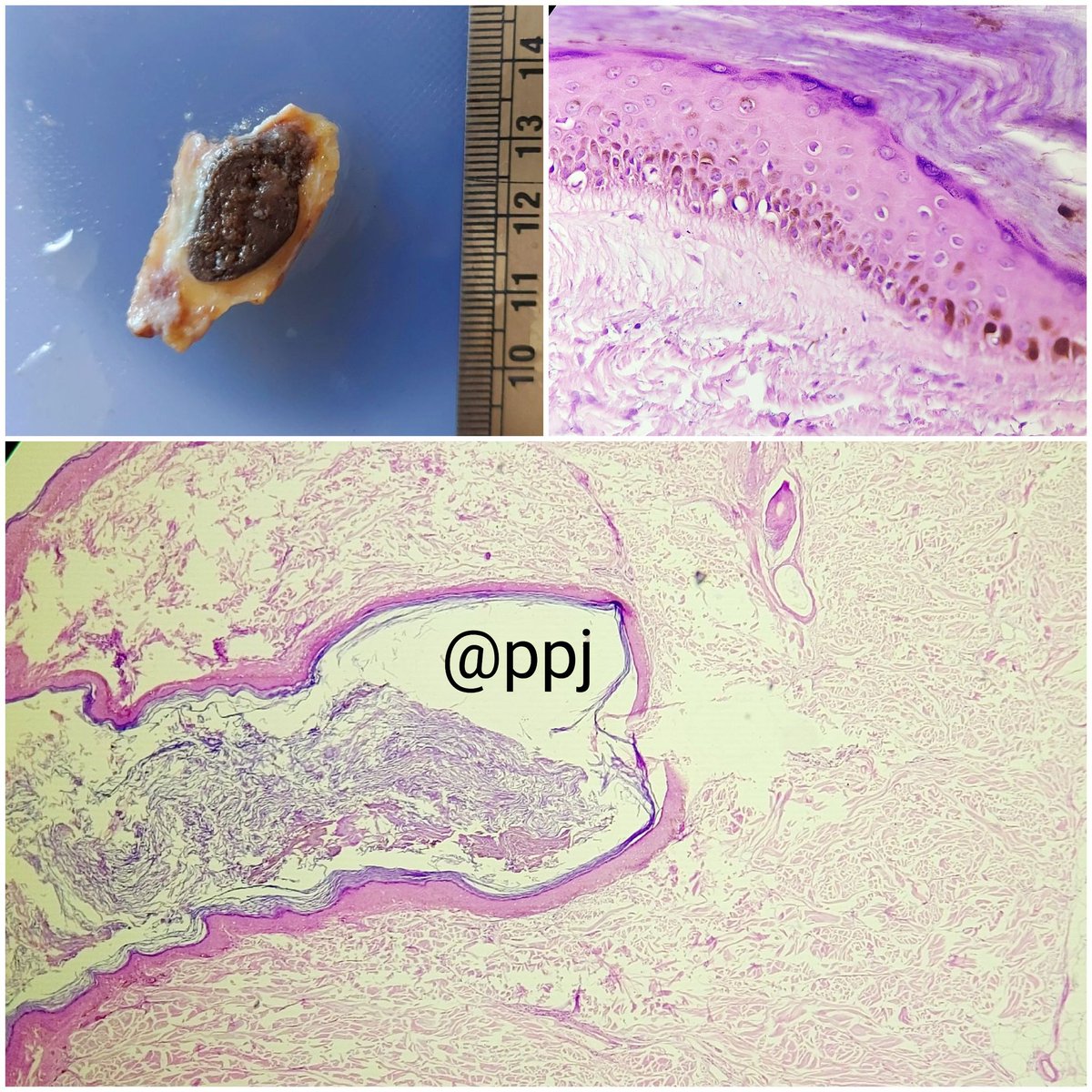 padmapathology1's tweet photo. Another pigmented epidermoid cyst. Caught it at #grosspath
#macromicrocorrelation https://t.co/BweJjh4a9x