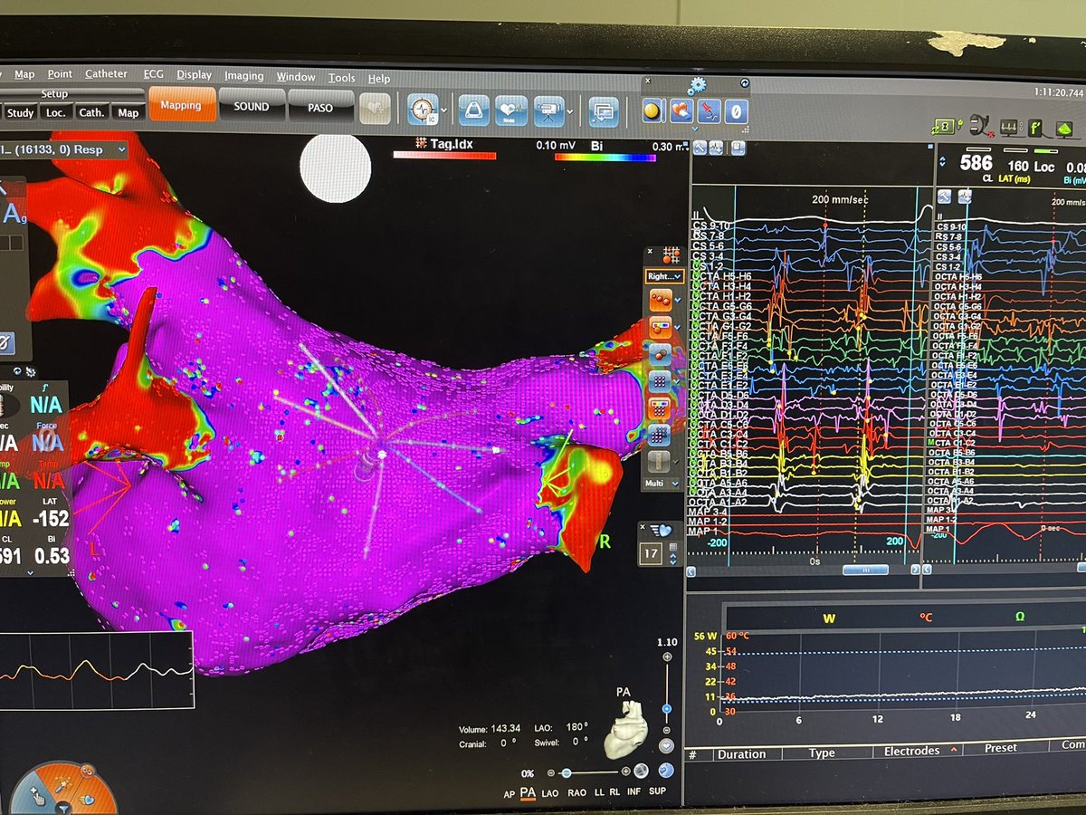 Anil Rajendra (@anilrajendra1) on Twitter photo First cases using #OCTARAY catheter. Used both standard with 2-2-2 spacing and long with 2-5-2. Very impressed with signal acquisition (>34,000 pts with standard) and signal quality. Excited to use it more for complex arrhythmias. #EPeeps  @BiosenseWebster First cases using #OCTARAY catheter. Used both standard with 2-2-2 spacing and long with 2-5-2. Very impressed with signal acquisition (>34,000 pts with standard) and signal quality. Excited to use it more for complex arrhythmias. #EPeeps  @BiosenseWebster