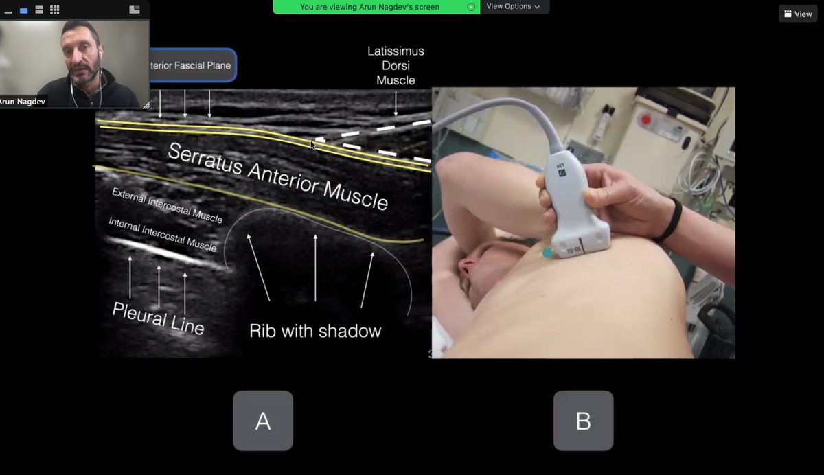 ColumbiaEMSono (@columbiaemsono) on Twitter photo So lucky to have <a href="/NagdevArun/">Arun Nagdev</a> from <a href="/HGHED/">Highland EM</a> teaching us innovative and multimodal ways of treating pain in Emergency Medicine. Cannot wait to use some of his techniques to improve our patient care!!! So lucky to have <a href="/NagdevArun/">Arun Nagdev</a> from <a href="/HGHED/">Highland EM</a> teaching us innovative and multimodal ways of treating pain in Emergency Medicine. Cannot wait to use some of his techniques to improve our patient care!!!