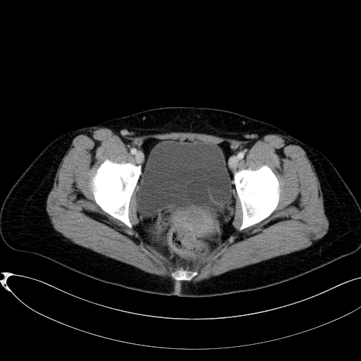 MDerigs's tweet photo. A CT scan (unfortunately no urography) confirmed a duplex kidney with a ureterocele #ureterocele #duplexkidney #CTscan https://t.co/j4FOvx6UJ6