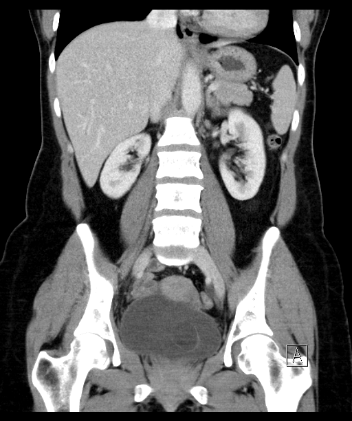 MDerigs's tweet photo. A CT scan (unfortunately no urography) confirmed a duplex kidney with a ureterocele #ureterocele #duplexkidney #CTscan https://t.co/j4FOvx6UJ6