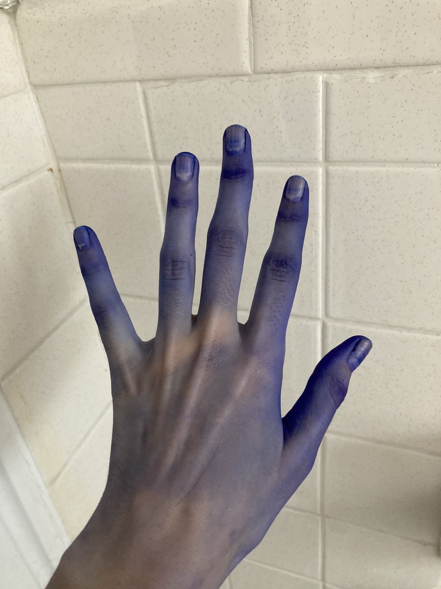 Villains_Co's tweet photo. I dyed my hair and this happened when I rinsed it, I look cool like Vee now ☺️

Also still enjoying my long break in America, thanks everyone for all the happy holidays wishes 😄
I’m having a blast here ! https://t.co/KdDg8rEeup