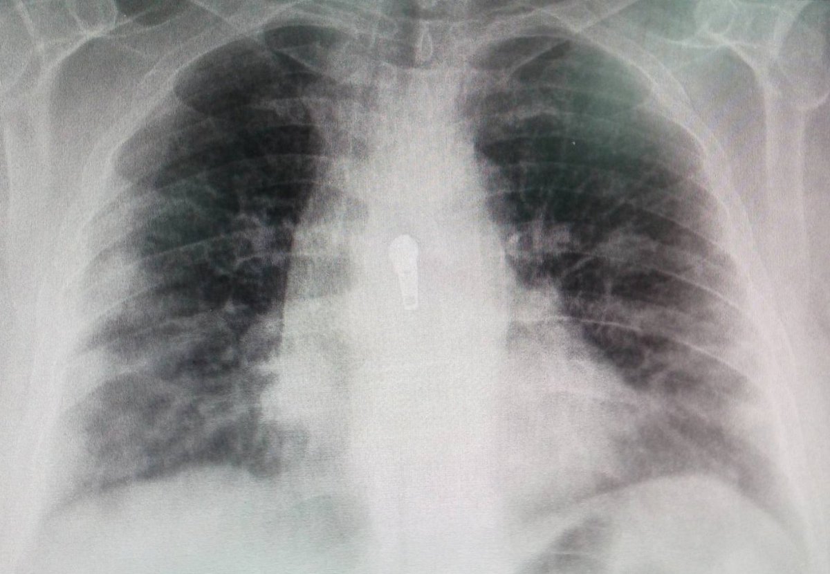 SlavicaPlavsic's tweet photo. Omikron soj je mnogo zarazniji i širi se mnogo brže u odnosu na delta soj. Za sada daje blaže kliničke slike,ali nije bezopasan i ne treba se zavaravati.I daje bilateralne pneumonije i ljudi mogu završiti i u bolnicama i na respiratorima.Naravno,mnogo češće nevakcinisani.(primer) https://t.co/Y5E2tki4xz