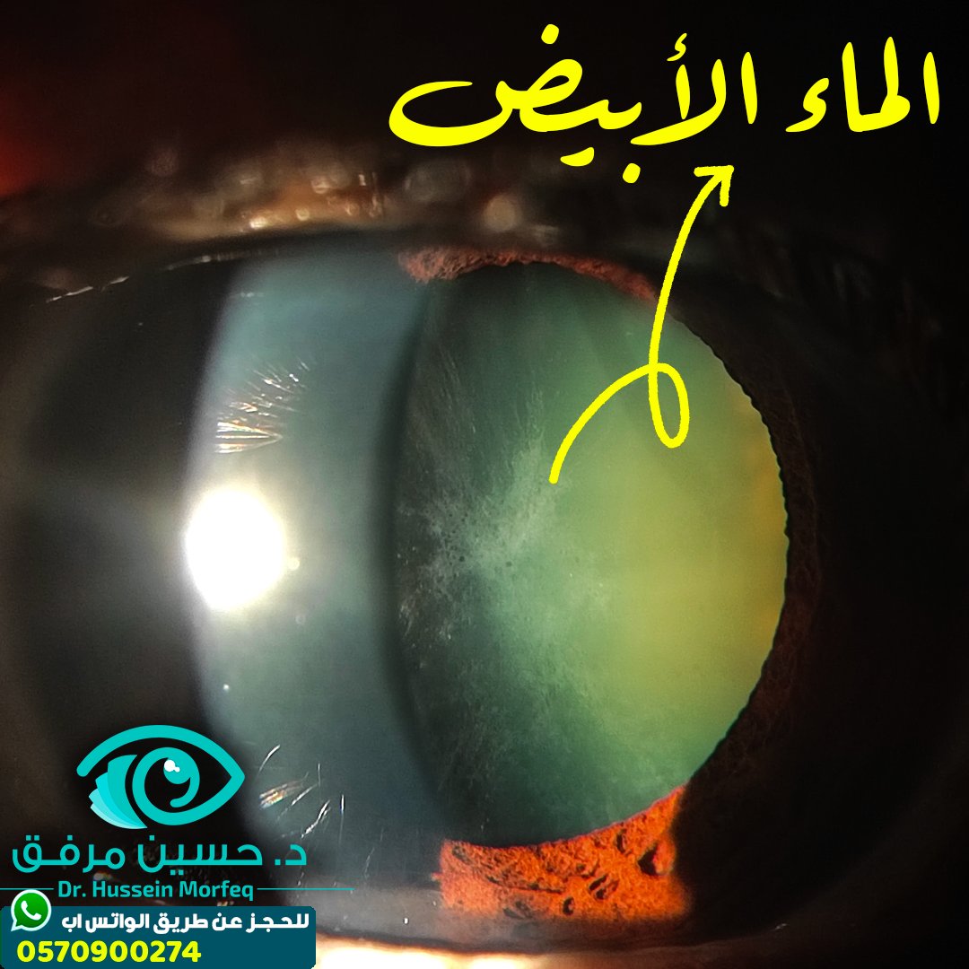 يرتبط إعتام عدسة العين (الماء الأبيض) بزيادة مستوى التعرض لأشعة الشمس. تجنب أشعة الشمس المباشرة و لبس النظارة الشمسية الخاصة بالحماية من الأشعة فوق البنفسجية تجنبك باذن الله من تكون الماء الأبيض مبكراً.

#صحتك #الماء_الأبيض #عيون #جدة #الساد #فضفضة_طبيب <a href="/6abeb_/">#صوت_الطبيب🩺</a> @Voice_6abeb