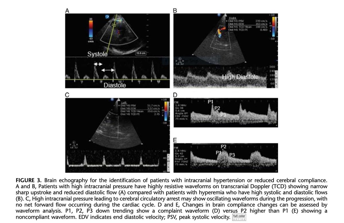 deepak_neuro's tweet photo. Perioperative #brain #echography has several potential applications beyond #neurocritical care but is underutilized. Our thoughts in @JNeurosurgAnes (Thanks to @chiara_robba &amp; @aartisarwal) #ultrasound #POCUS #anesthesia #criticalcare @SNACCNeuro
https://t.co/iu1dlmtggI https://t.co/YccNGBurHo