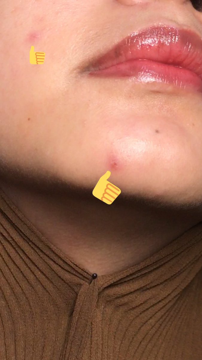 kforkinsley's tweet photo. Mumpung ada beberapa dark spot & redness diwajahku, aku mau cobain nih rutin tiap harii pake moisturizernya. Hmm mari kita liat nanti yaah, setelah 2-3 minggu pemakaian.
YUHUUU GASABAR MAU LIAT HASILNYA 🥺🥺
#BasictobeTrue @avoskinbeauty
#racunskincare #racunskincaremakeup https://t.co/DRZCgSvPJm