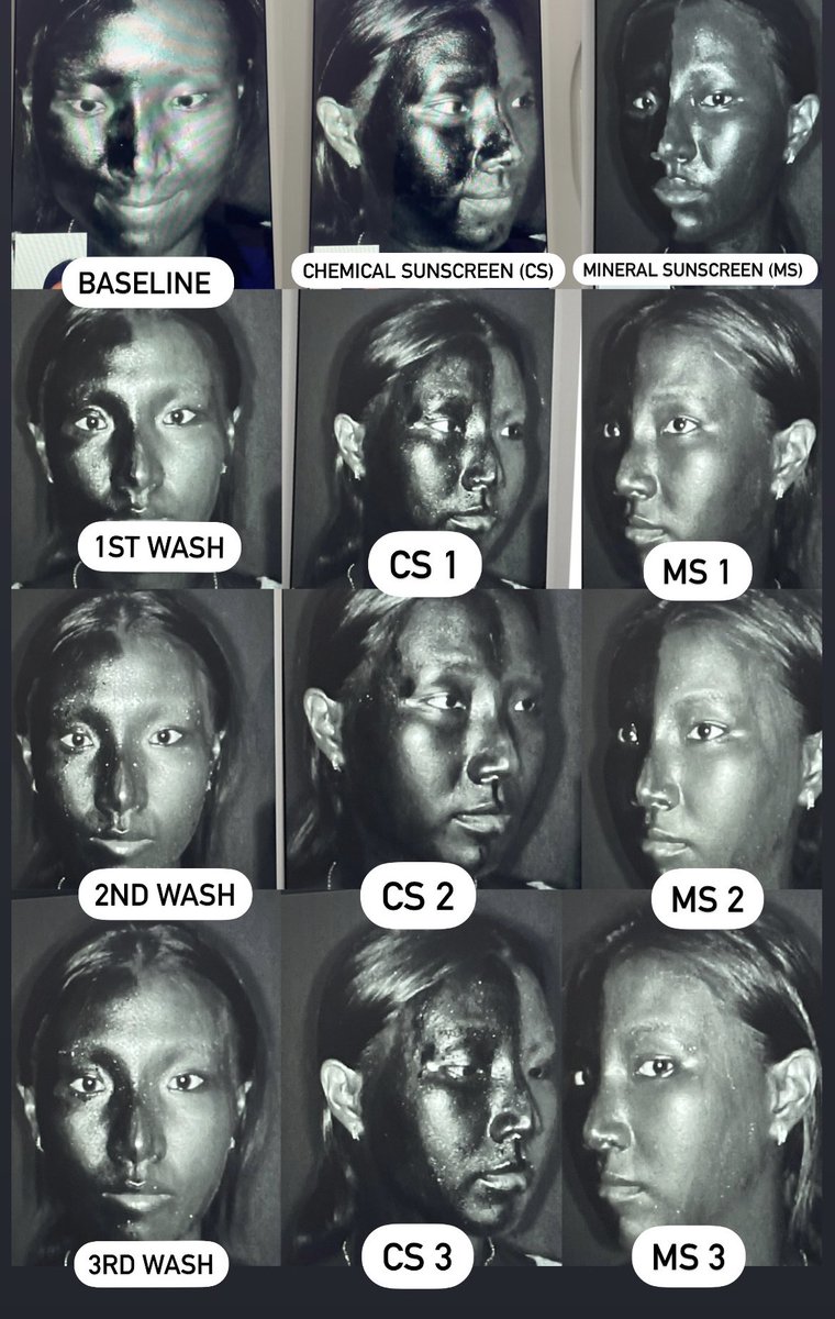 funskincare_'s tweet image. #funexperiment Simulasi wudhu: mencuci wajah tiga kali dengan air dan dampaknya pada lapisan sunscreen non-water-resistant (tiga jam setelah pemakaian awal)

cs = chemical sunscreen
ms = mineral sunscreen
Angka = jumlah bilasan