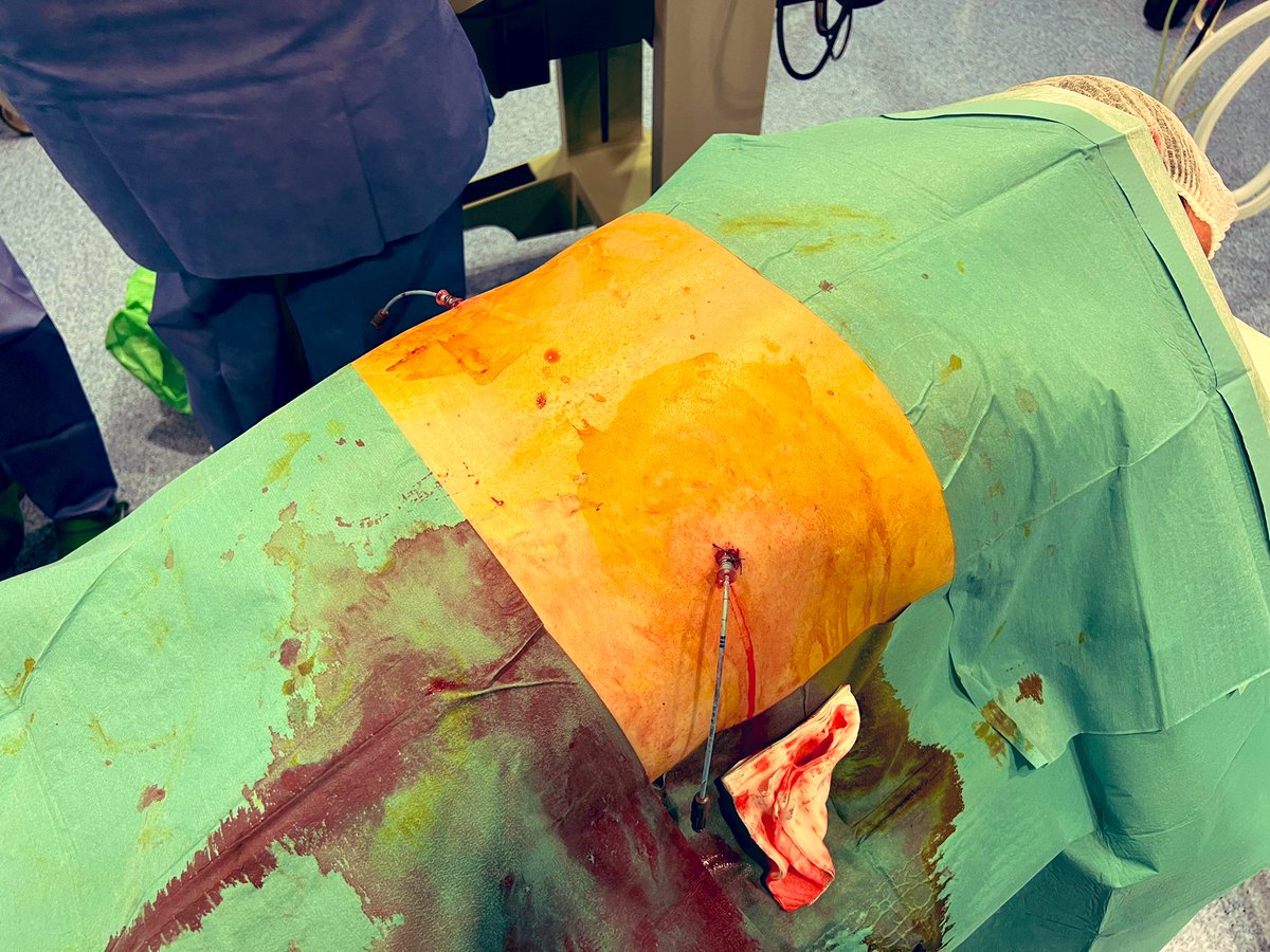 jl_uro's tweet photo. Días de guardias, no soy fan pero aún hay gente que pone nefrostomias en Prono. Confirmen. 
Tranquilos, gran parte de lo teñido es Betadine. Pcte de Creatinina 7 => 2mg/dl 

He’s safe! 
#urology #surgery https://t.co/ZbQ5NwhFPq