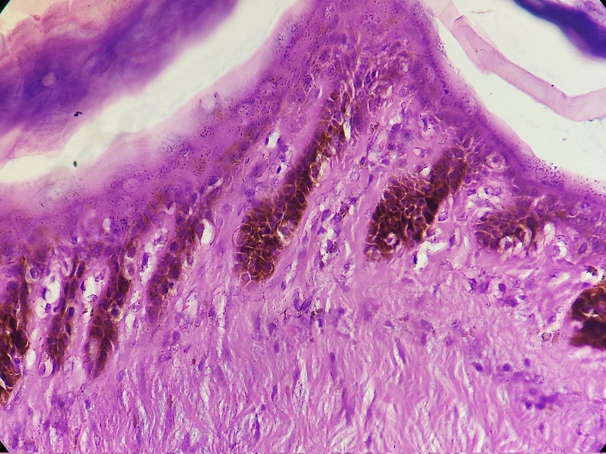 padmapathology1's tweet photo. Weird epidermoid cyst with pigmentation. Is there any other name for it? #dermpath @HENRYY_MD @Dermpathl @gonzadetoro @PIorfino https://t.co/BthXMgQ3iD