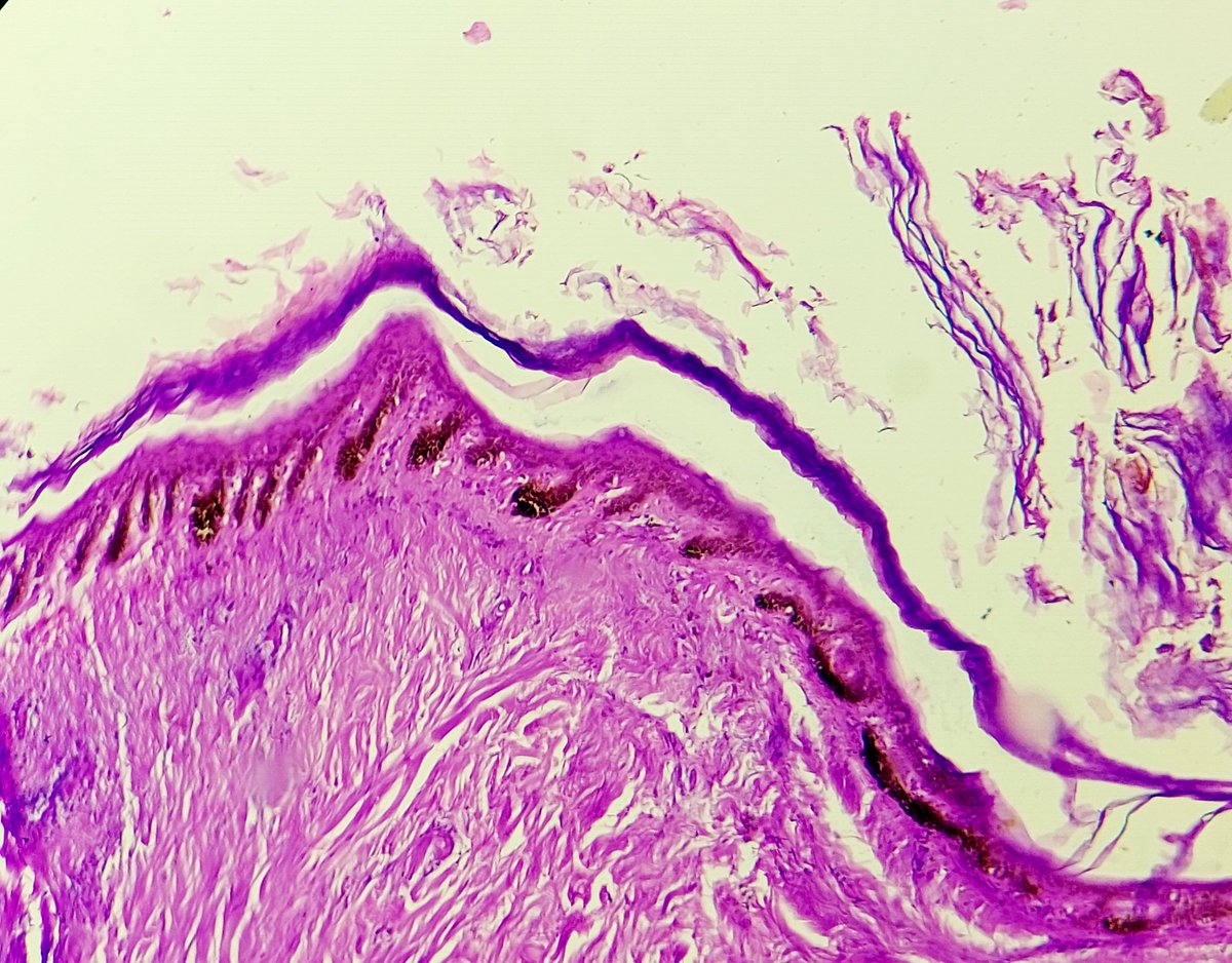 padmapathology1's tweet photo. Weird epidermoid cyst with pigmentation. Is there any other name for it? #dermpath @HENRYY_MD @Dermpathl @gonzadetoro @PIorfino https://t.co/BthXMgQ3iD