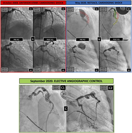 Emergency treatment of a giant coronary aneurysm: percutaneous intervention with coronary and peripheral tools, by Quadri et al
Tools used: 1 IABP, 4 coronary DES, 8 coronary covered stents, 1 peripheral covered stent, and 6 coils
academic.oup.com/eurheartj/arti…